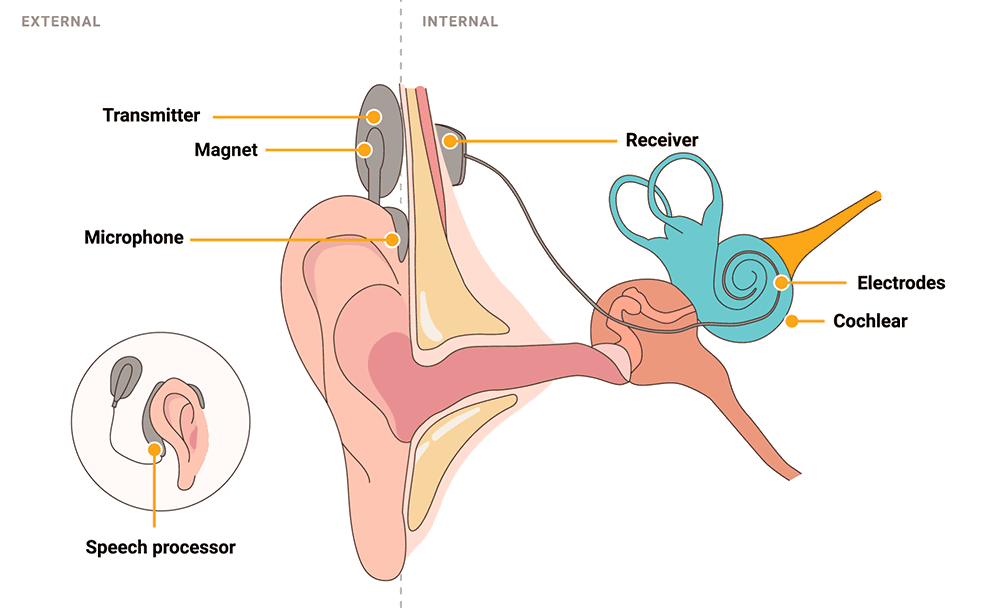Image showing how cochlear implant works